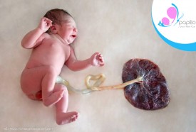 Lotus Birth (Another Treatment of Cord Care)